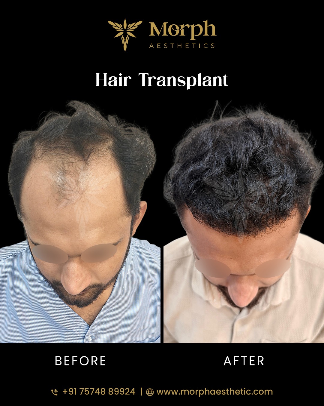 Before and after hair transplant result 4