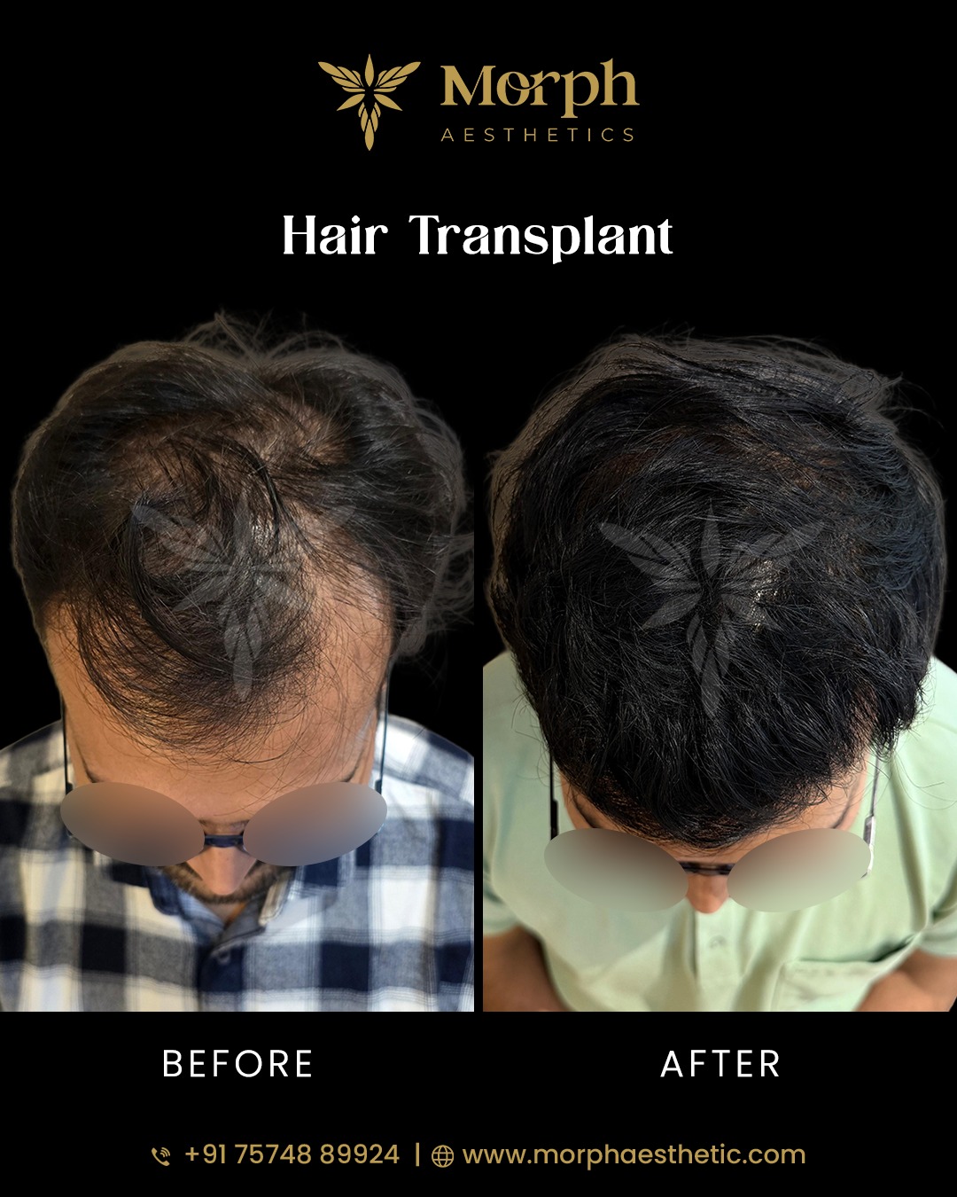 Before and after hair transplant result 5