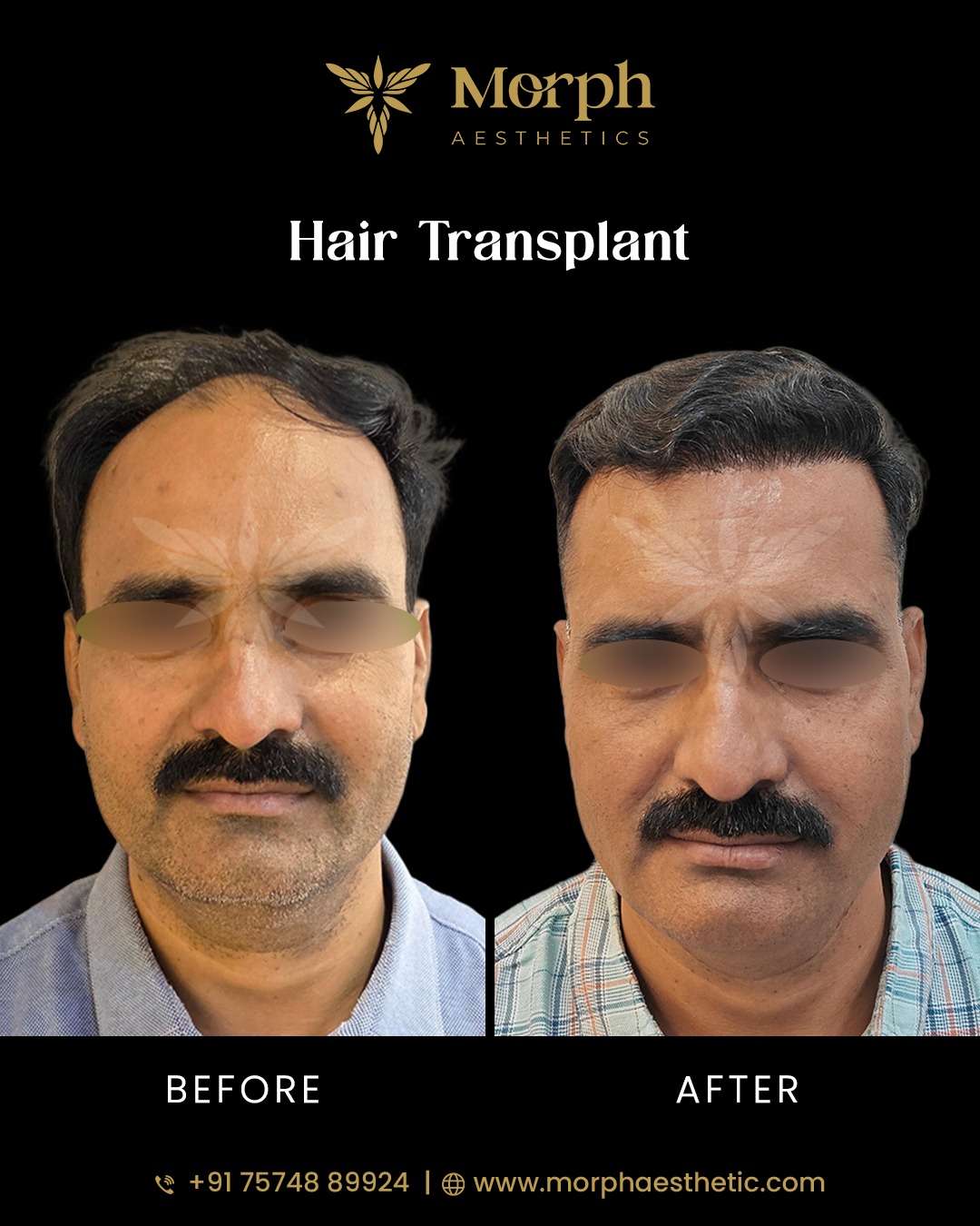Before and after hair transplant result 3