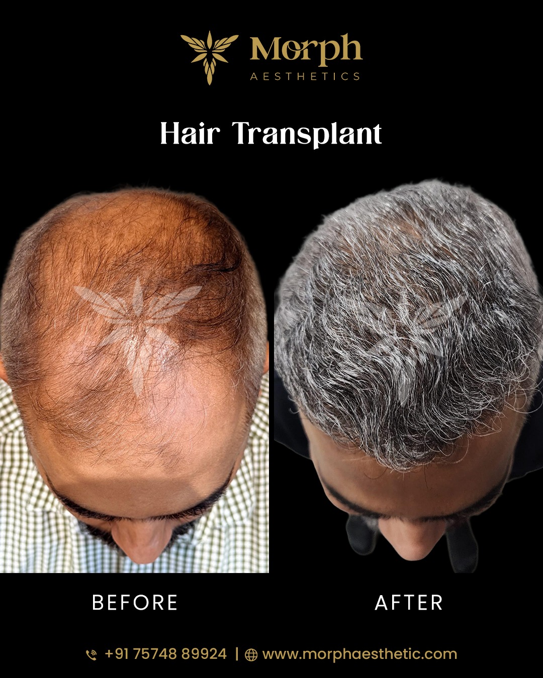 Before and after hair transplant result 6